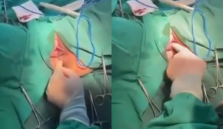 a hospital affiliated with shanxi medical university of china live-streamed a gynecological surgery, revealing the patient's privacy. the uncensored broadcast attracted tens of thousands of viewers! 1